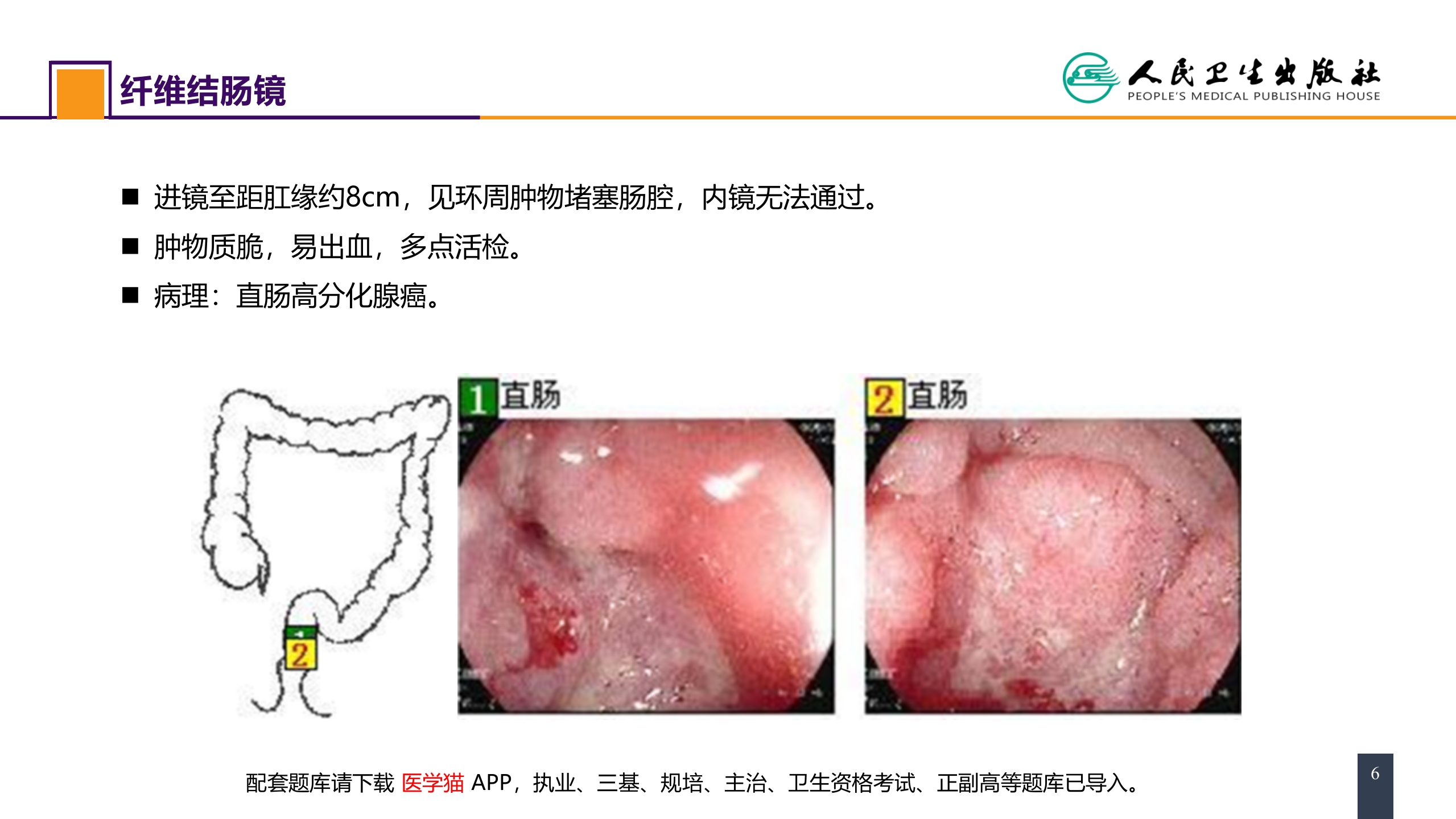 第三十七章 结、直肠与肛管疾病 案例分析-直肠癌