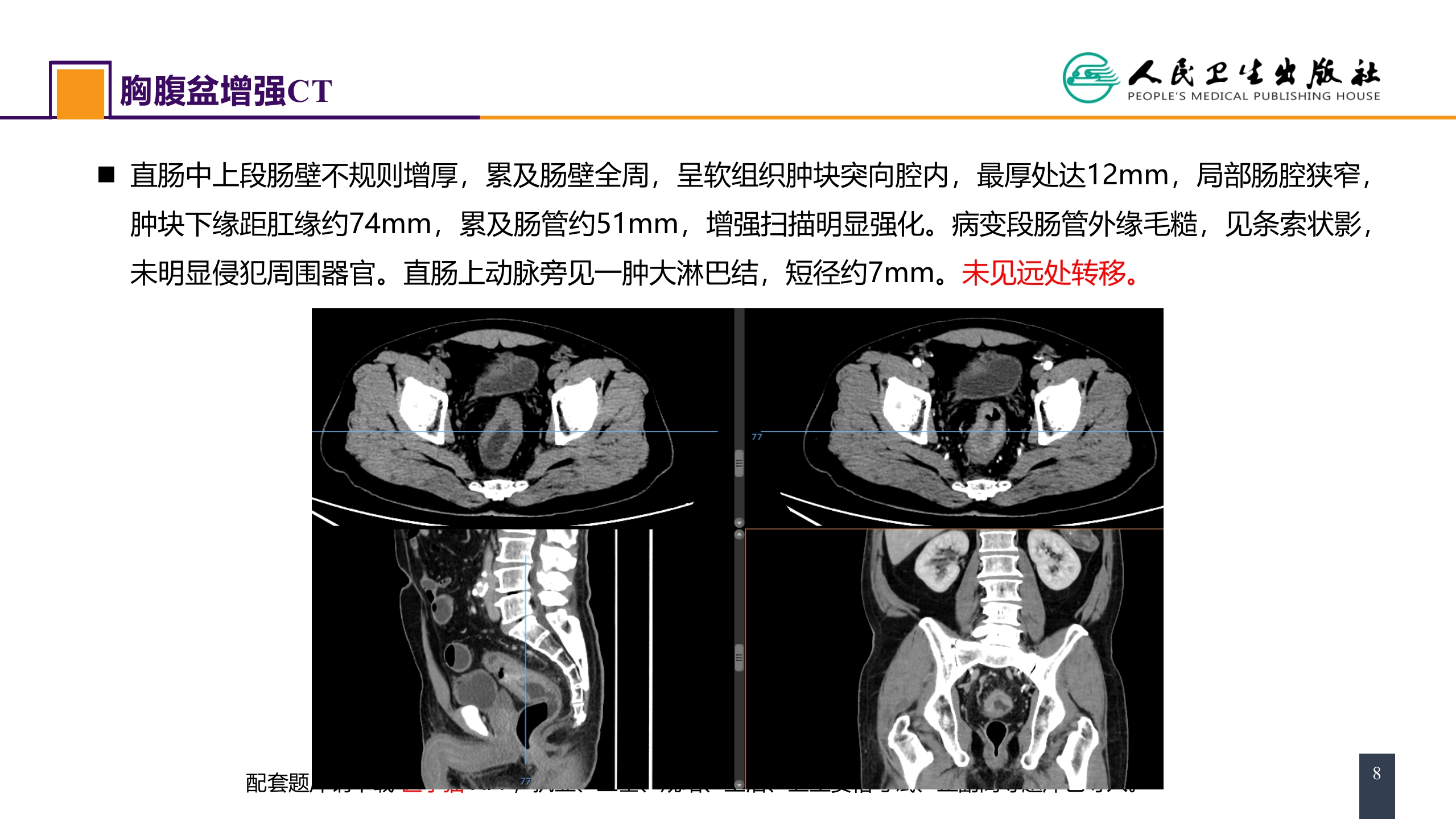 第三十七章 结、直肠与肛管疾病 案例分析-直肠癌