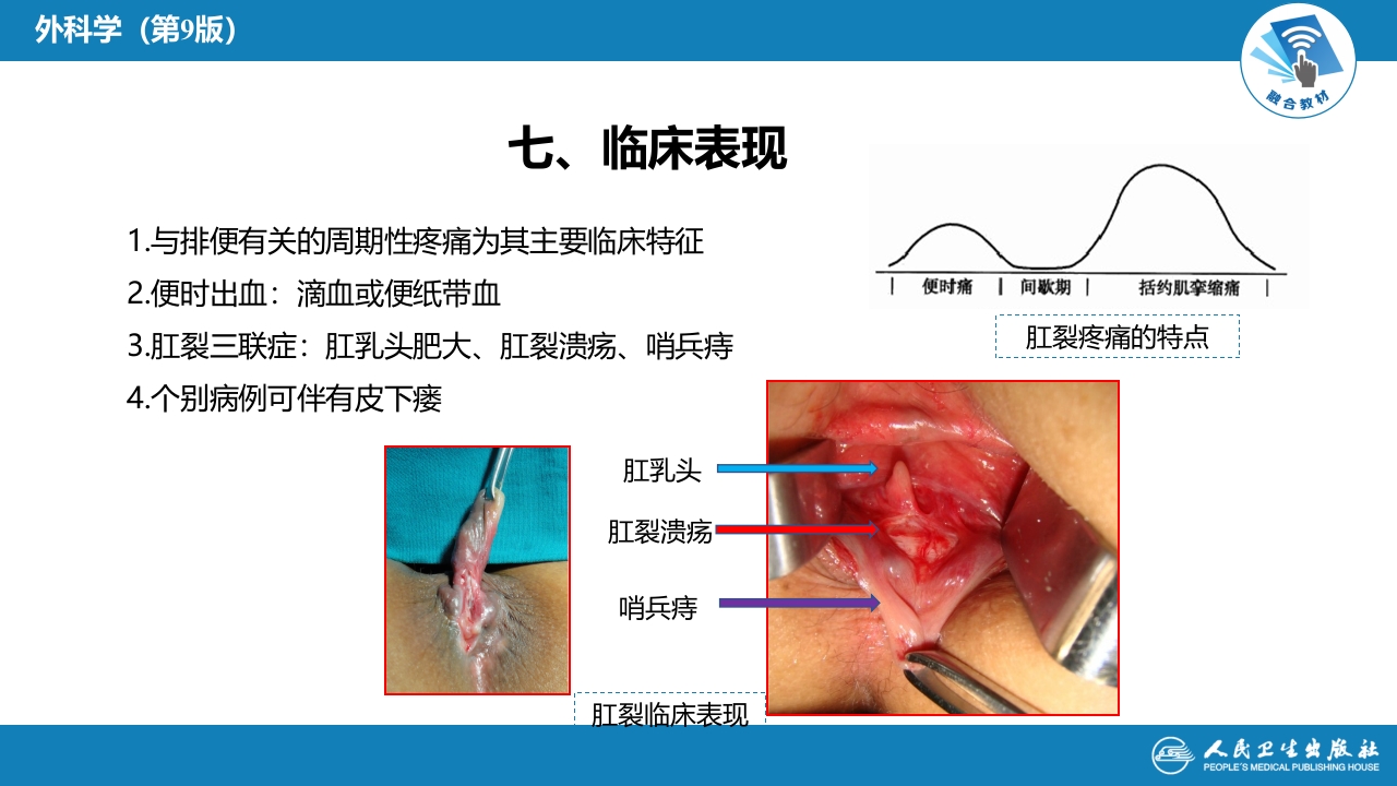 第三十七章 结、直肠与肛管疾病 第九、十、十一节 (1)