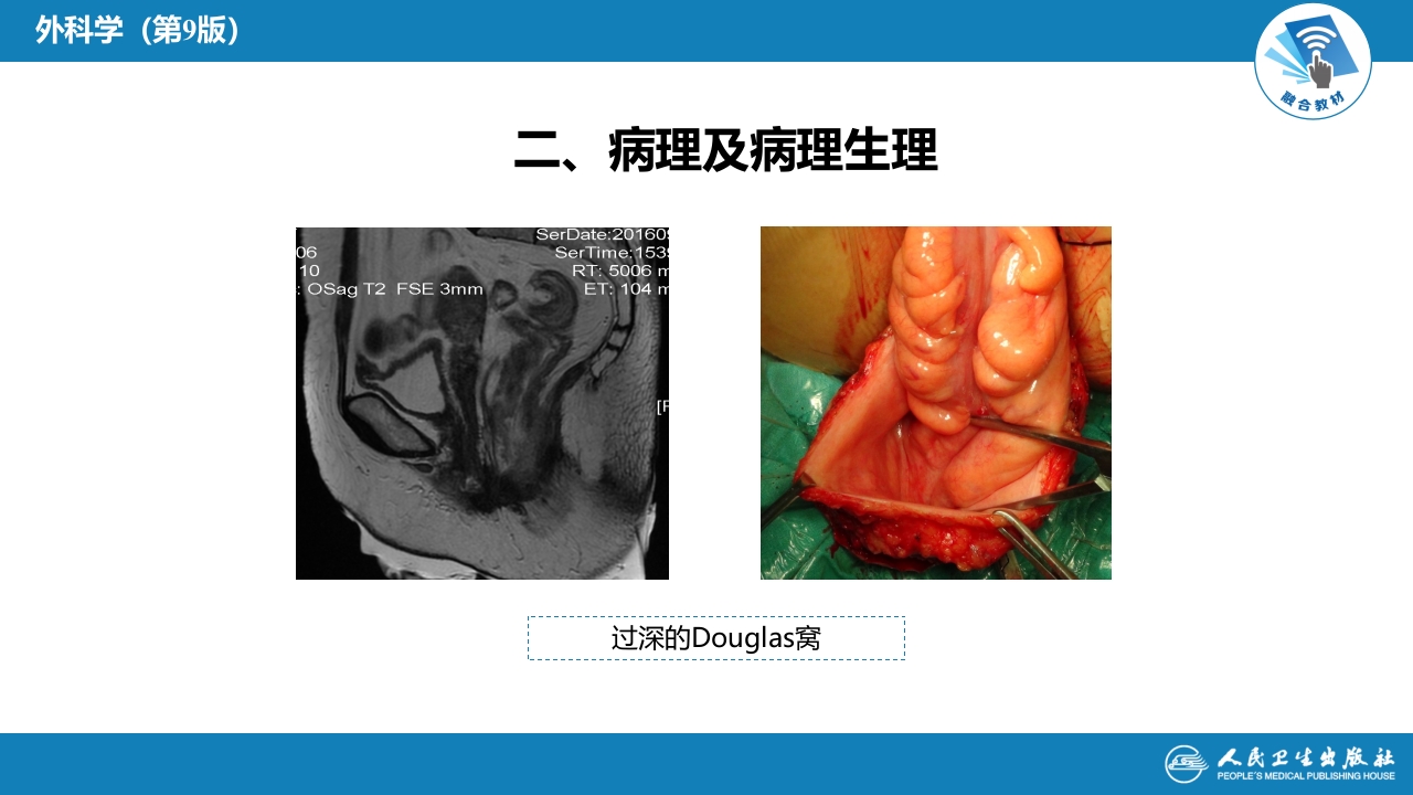 第三十七章 结、直肠与肛管疾病 第十三节 直肠脱垂