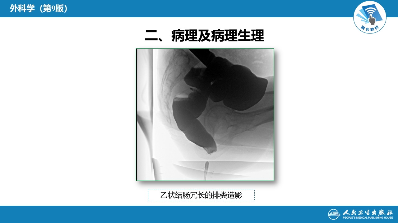 第三十七章 结、直肠与肛管疾病 第十三节 直肠脱垂