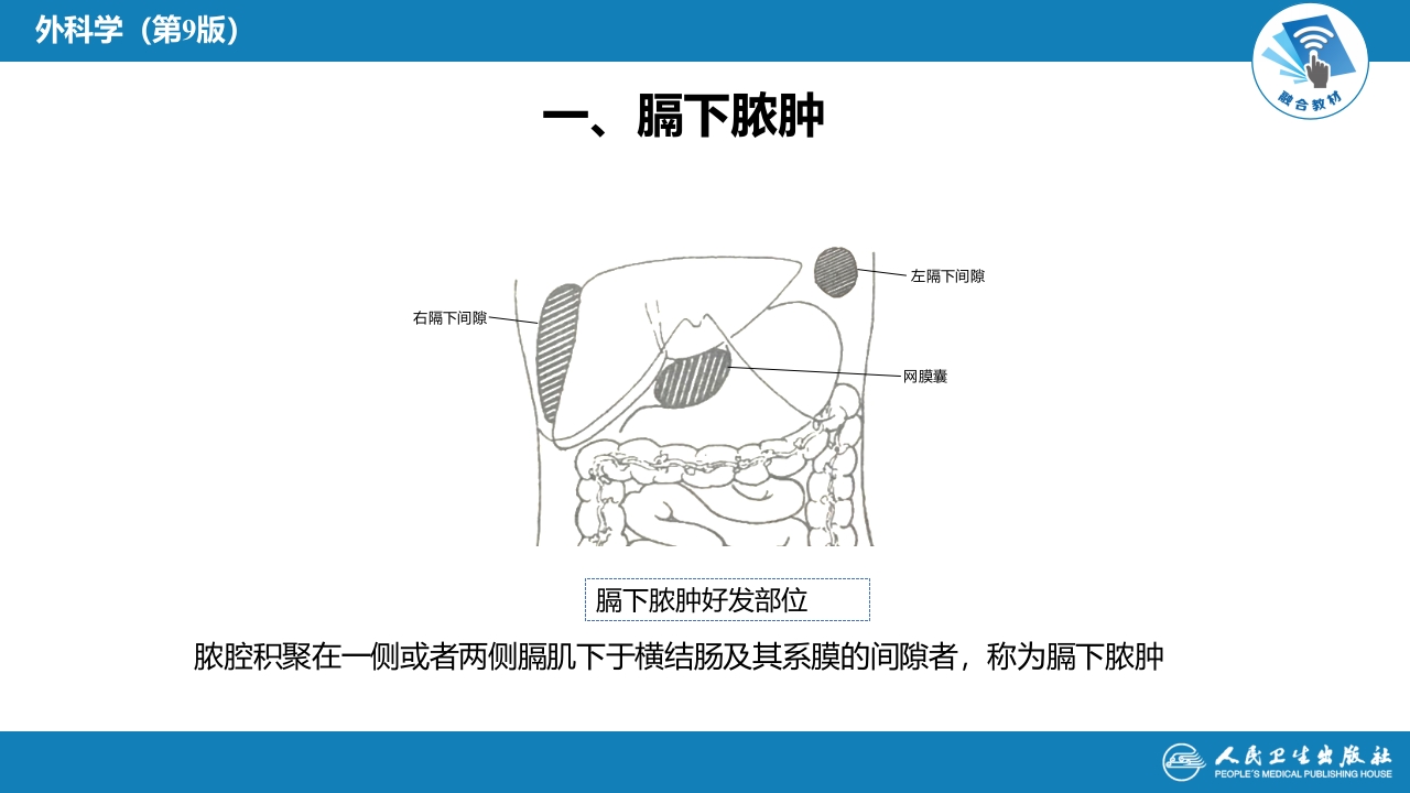 第三十三章 急性化脓性腹膜炎 第二节 腹腔脓肿