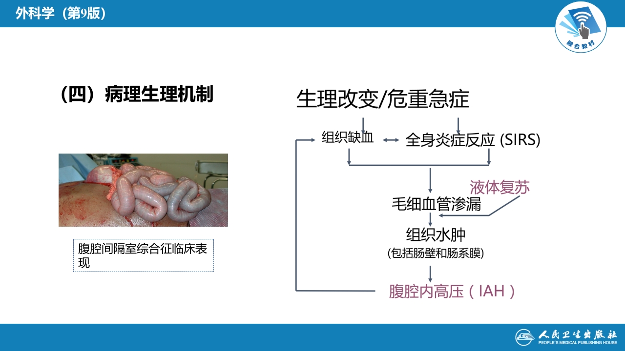 第三十三章 急性化脓性腹膜炎 第三节 腹腔间隔室综合征
