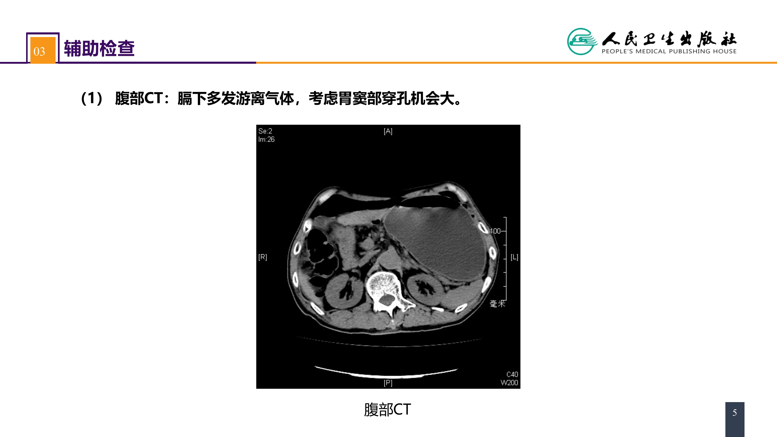 第三十四章 胃十二指肠疾病 案例分析-胃十二指肠溃疡伴穿孔