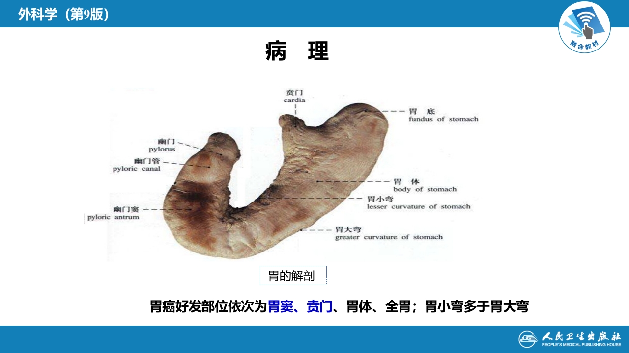 第三十四章 胃十二指肠疾病 第三节（一）胃癌