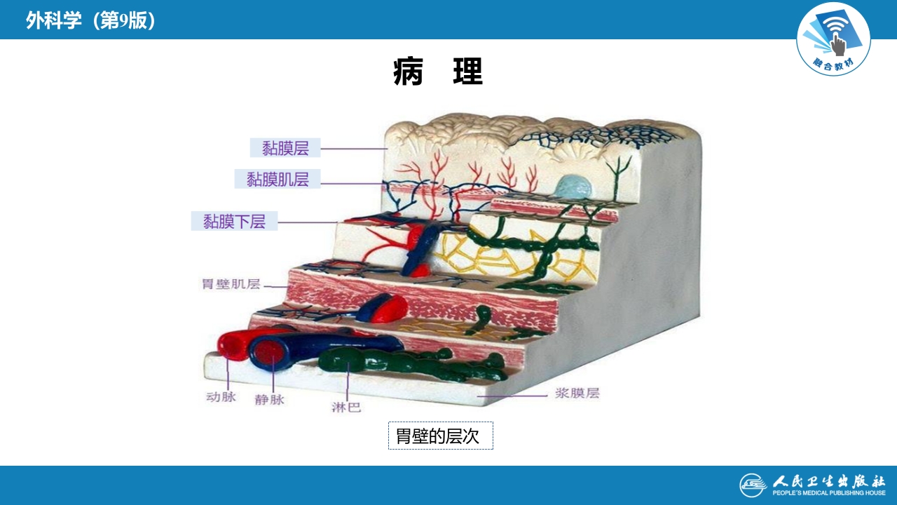 第三十四章 胃十二指肠疾病 第三节（一）胃癌