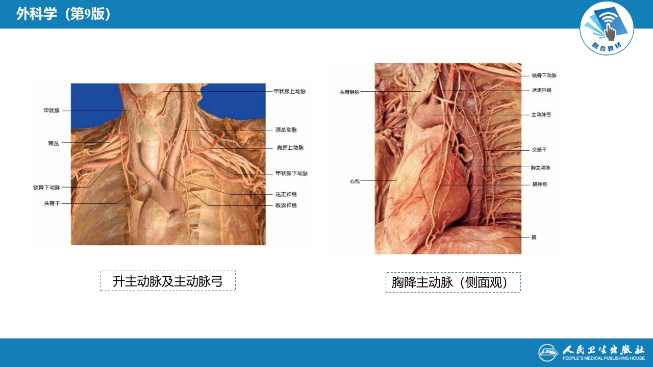 第三十章 胸主动脉疾病