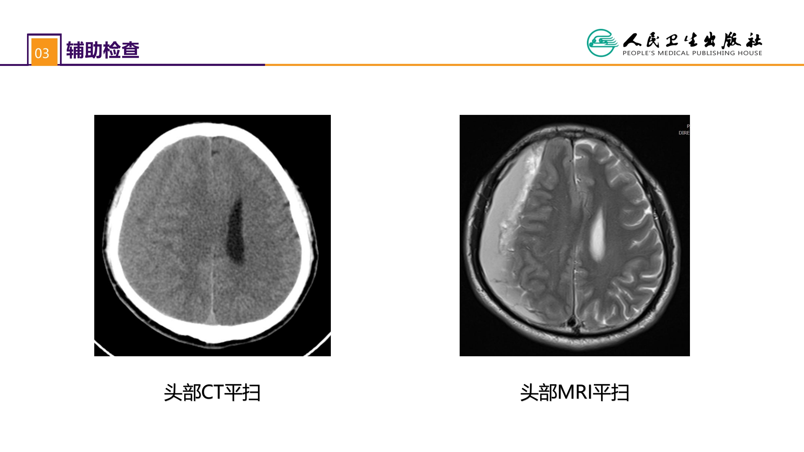 第十八章 颅脑损伤 案例分析-慢性硬膜下血肿