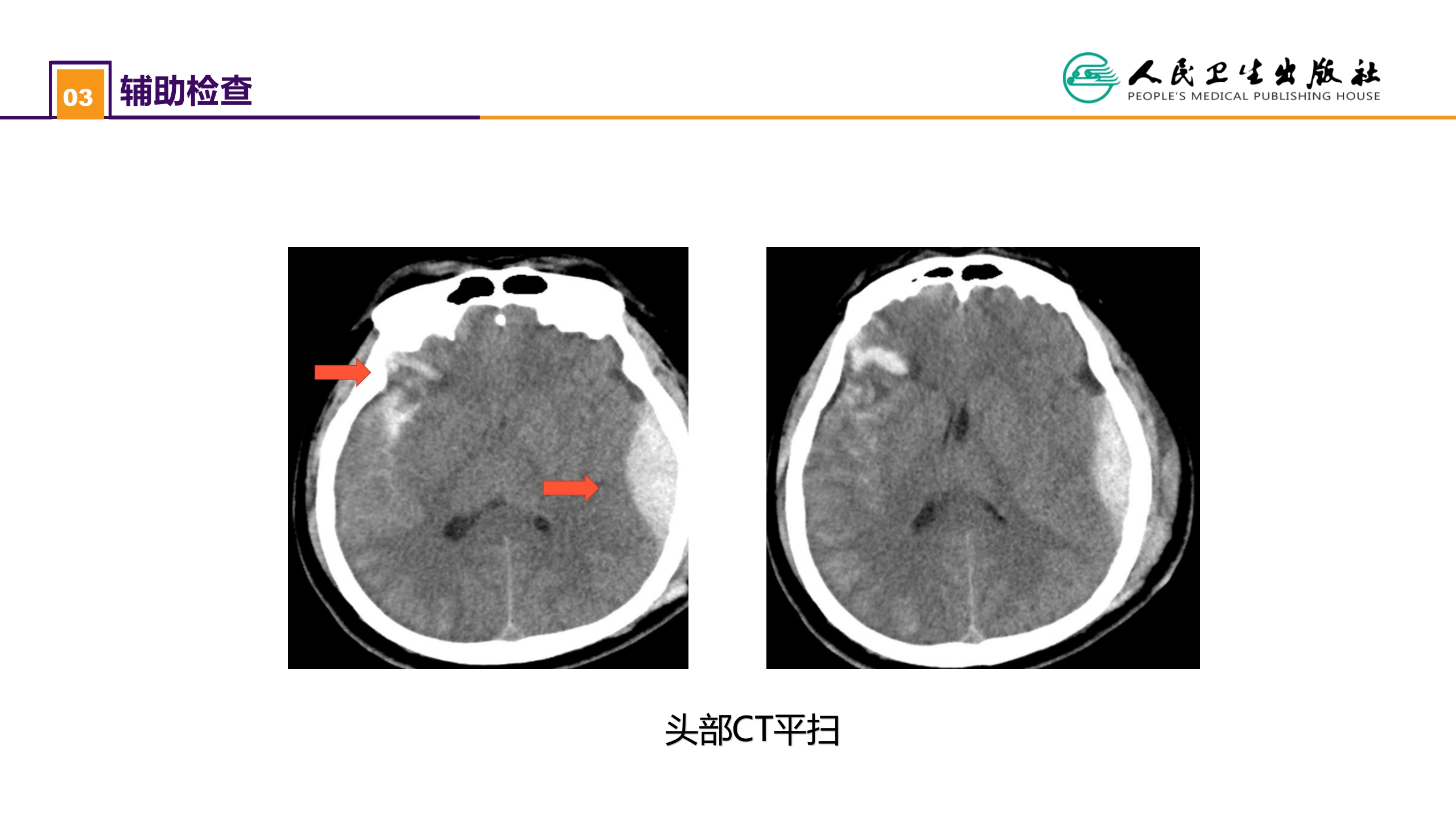 第十八章 颅脑损伤 案例分析-重型颅脑损伤