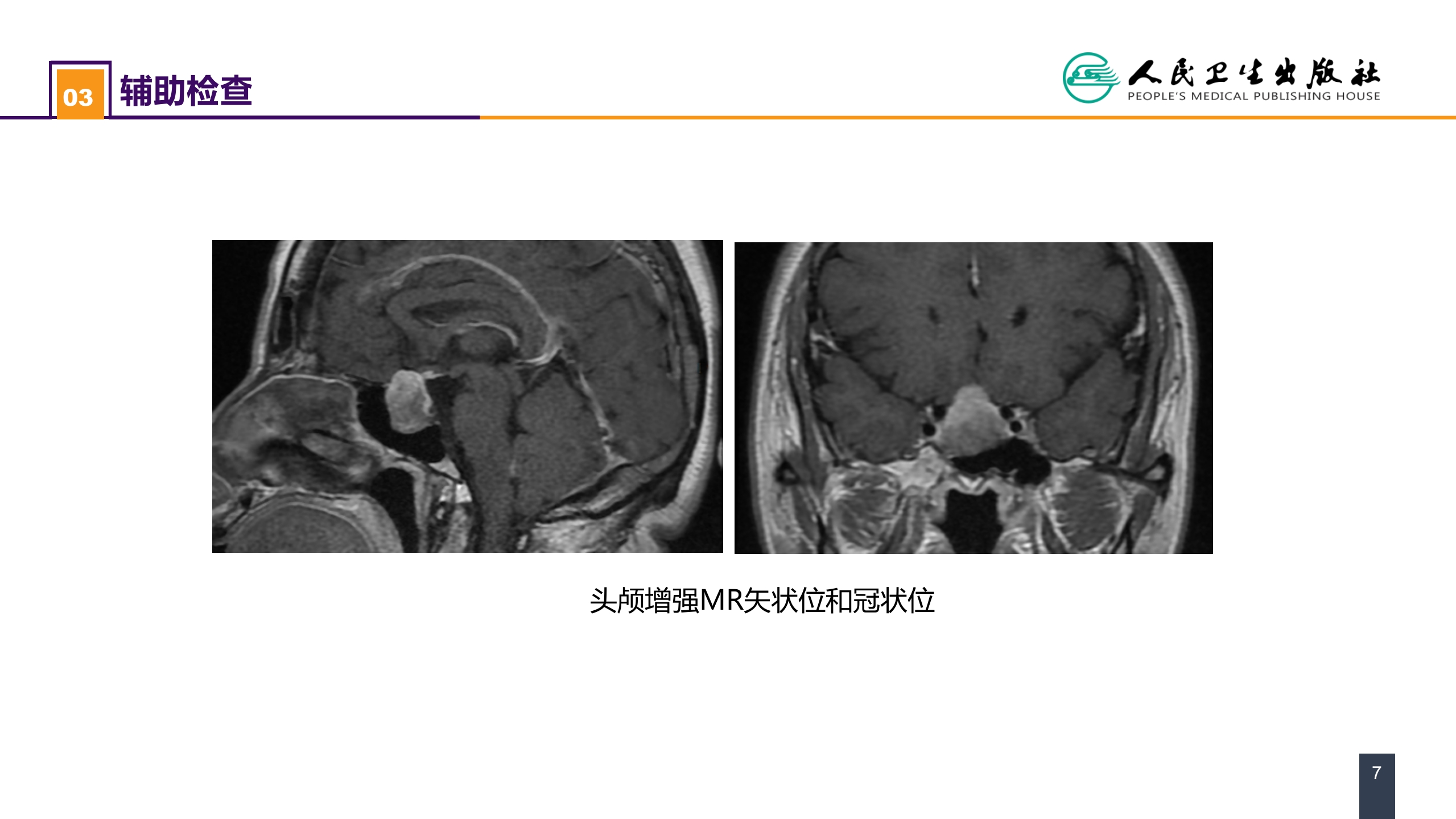 第十九章 案例分析-垂体腺瘤