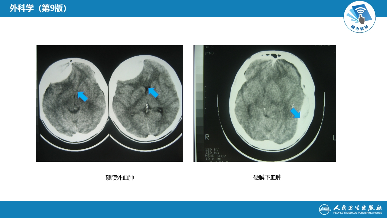 第十七章 颅内压增高和脑疝