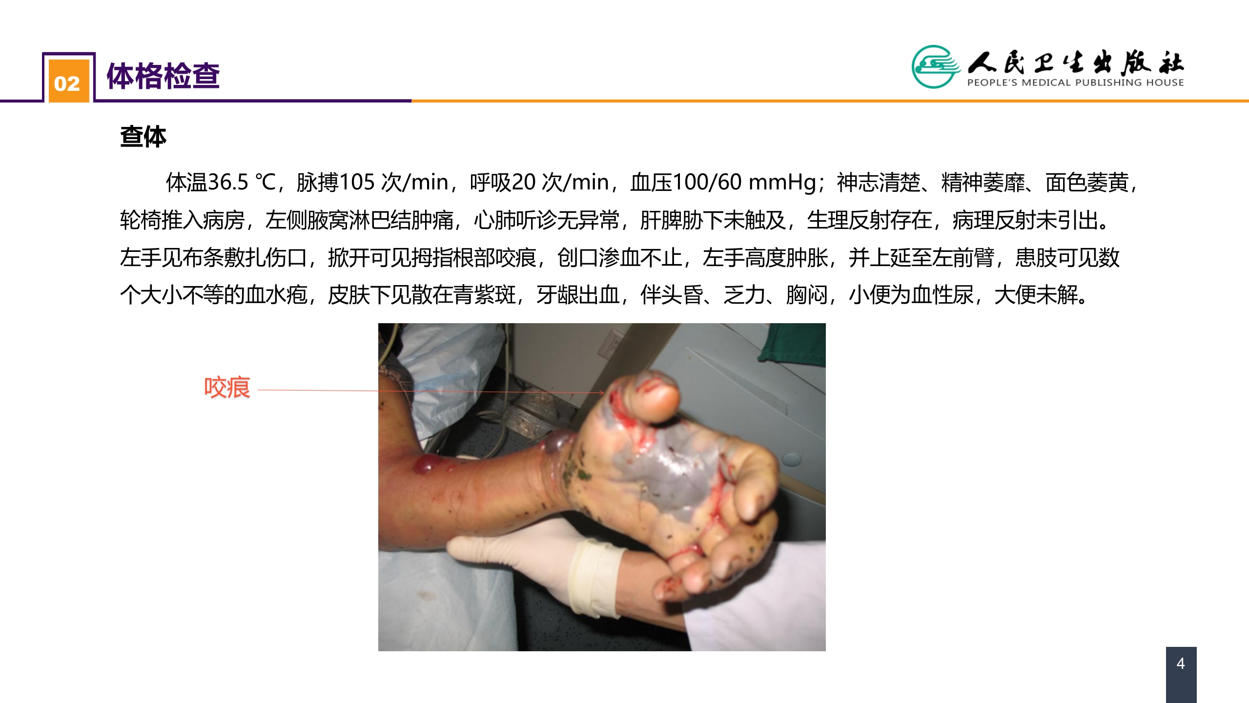 第十三章 烧伤、冻伤、蛇咬伤、犬咬伤、虫蛰伤 案例分析-蛇咬伤