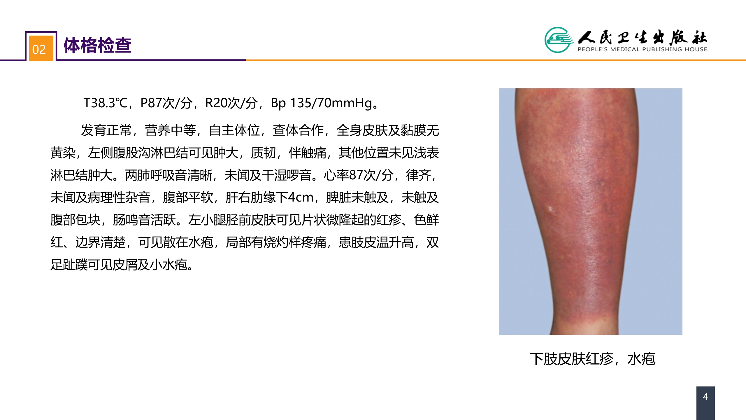 第十一章 案例分析-丹毒
