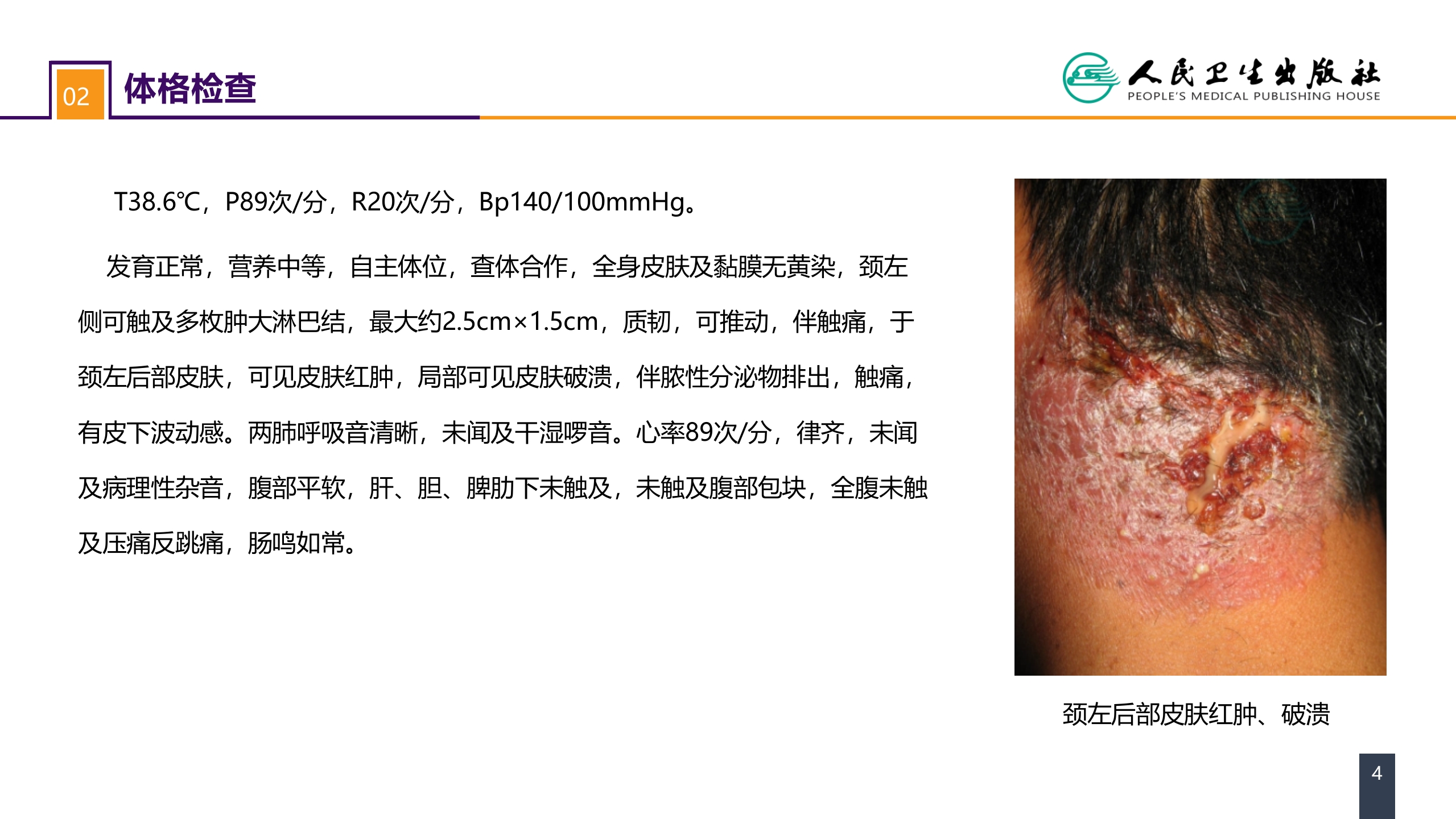 第十一章 案例分析-痈