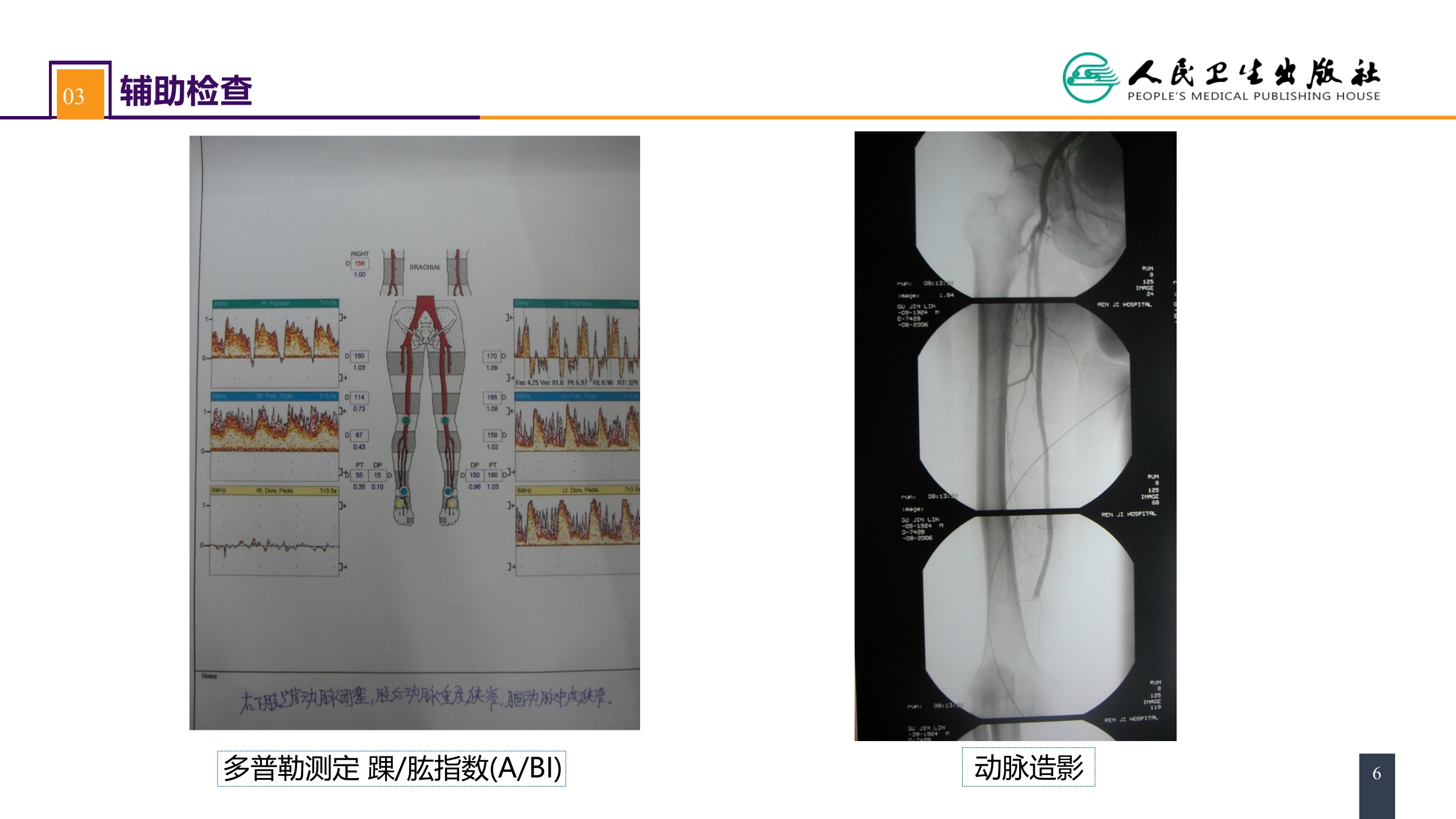 第四十五章 周围血管与淋巴管疾病 案例分析-动脉栓塞