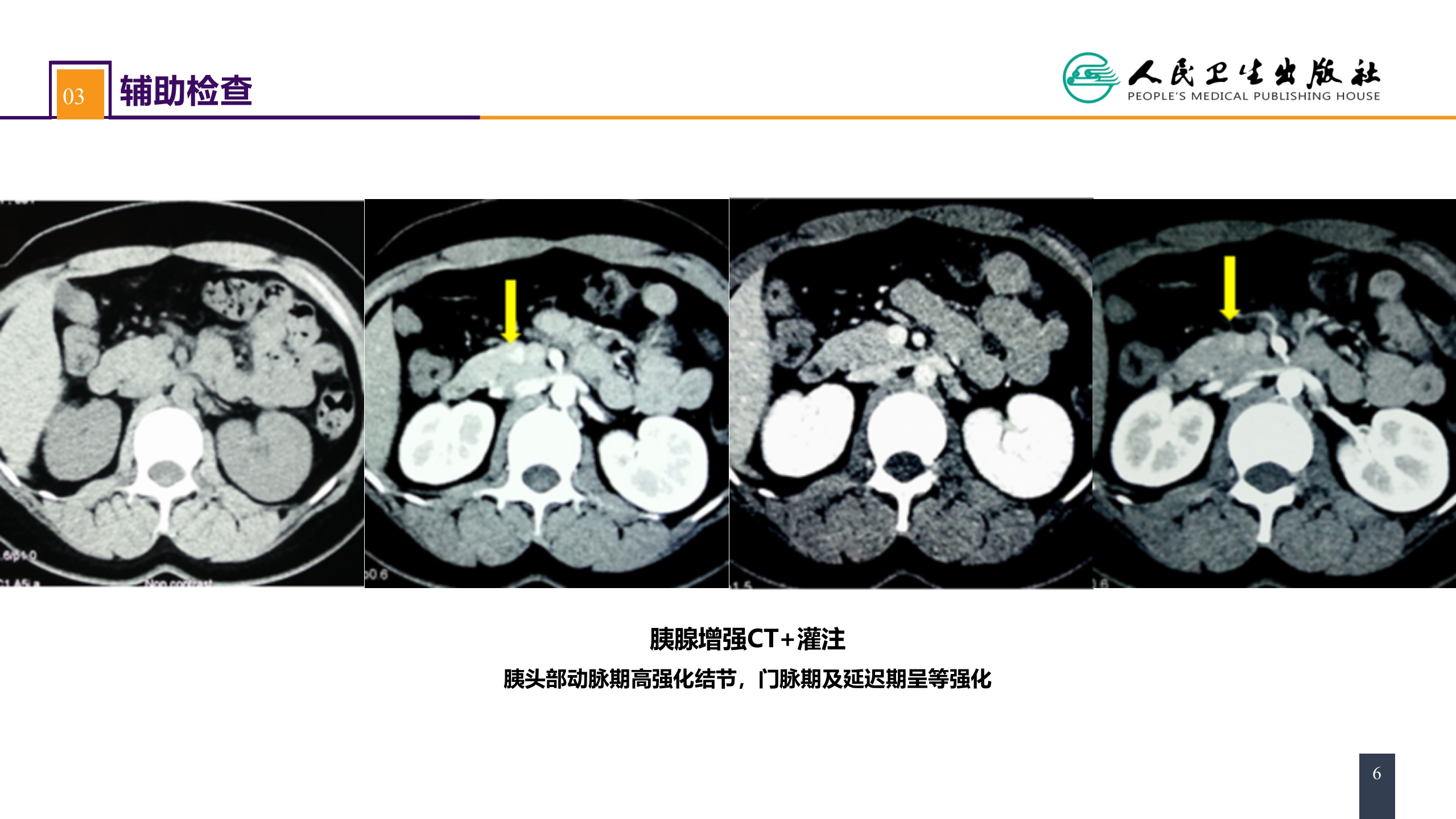 第四十一章 胰腺疾病 案例分析-胰岛素瘤