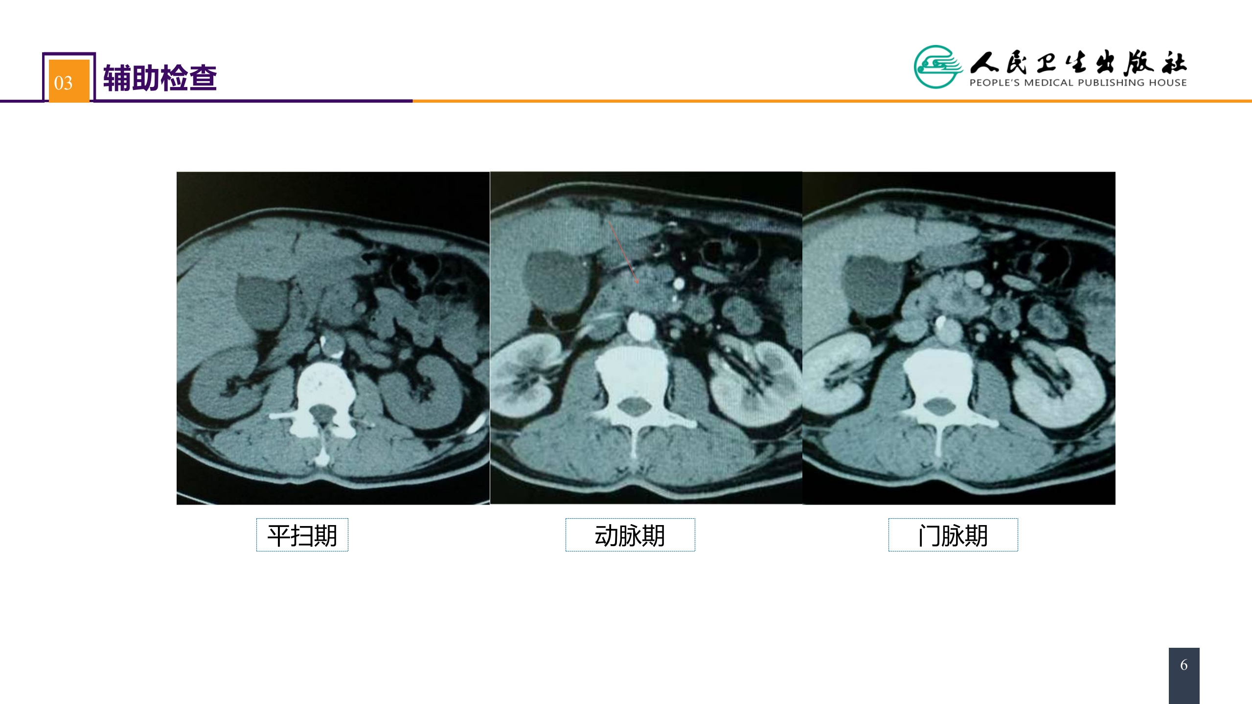 第四十一章 胰腺疾病 案例分析-胰腺癌