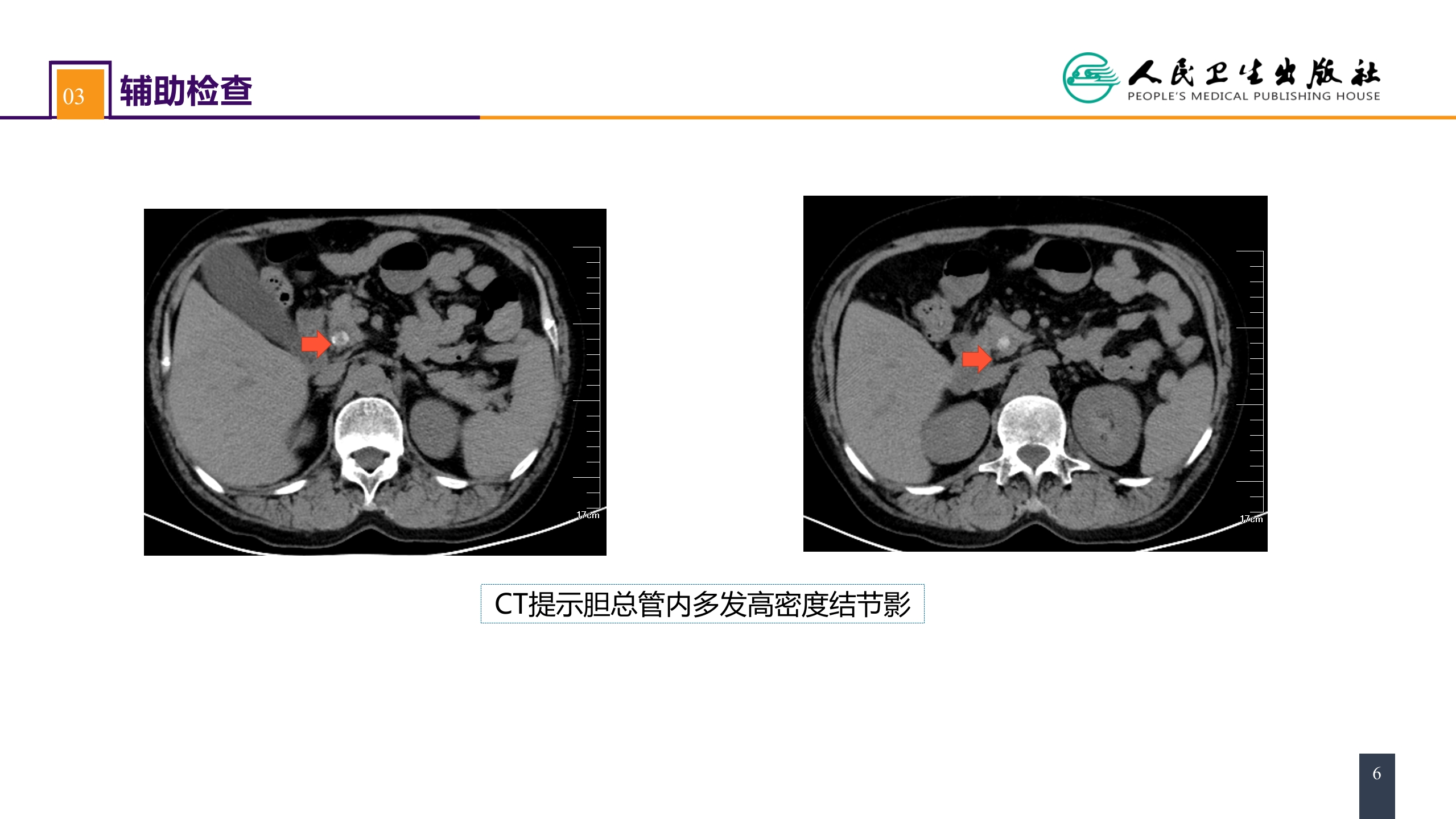 第四十章 胆道疾病 案例分析-肝外胆管结石