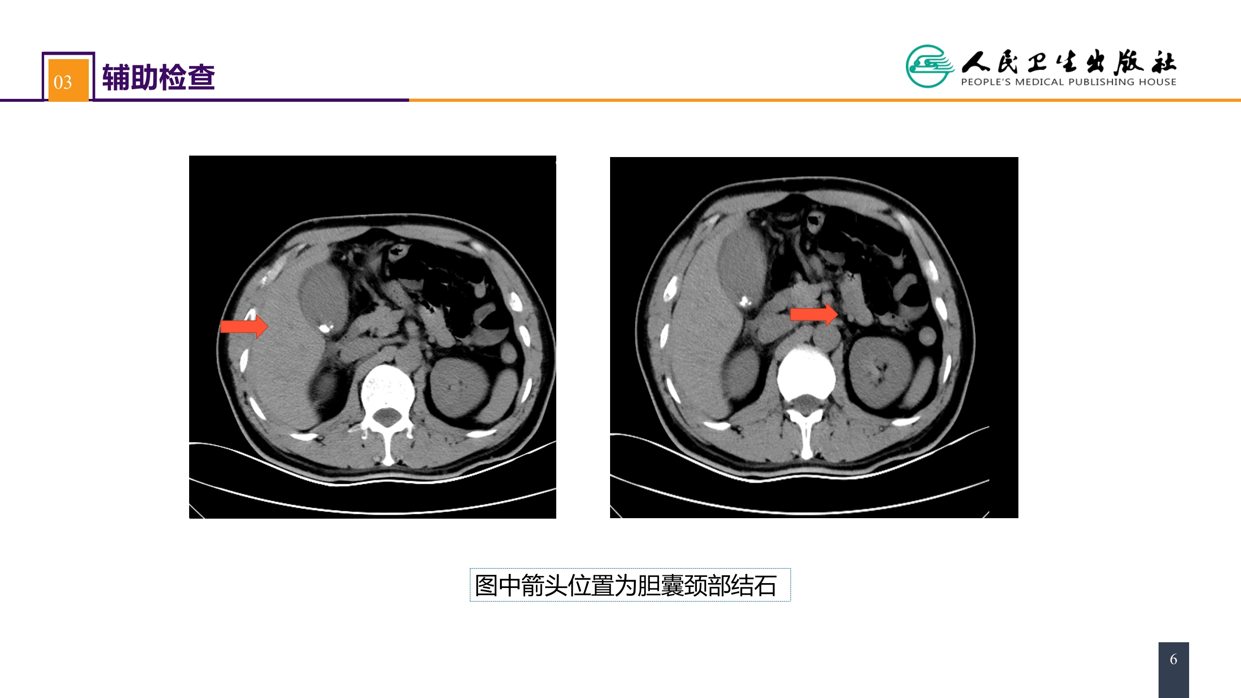 第四十章 胆道疾病 案例分析-急性胆囊炎