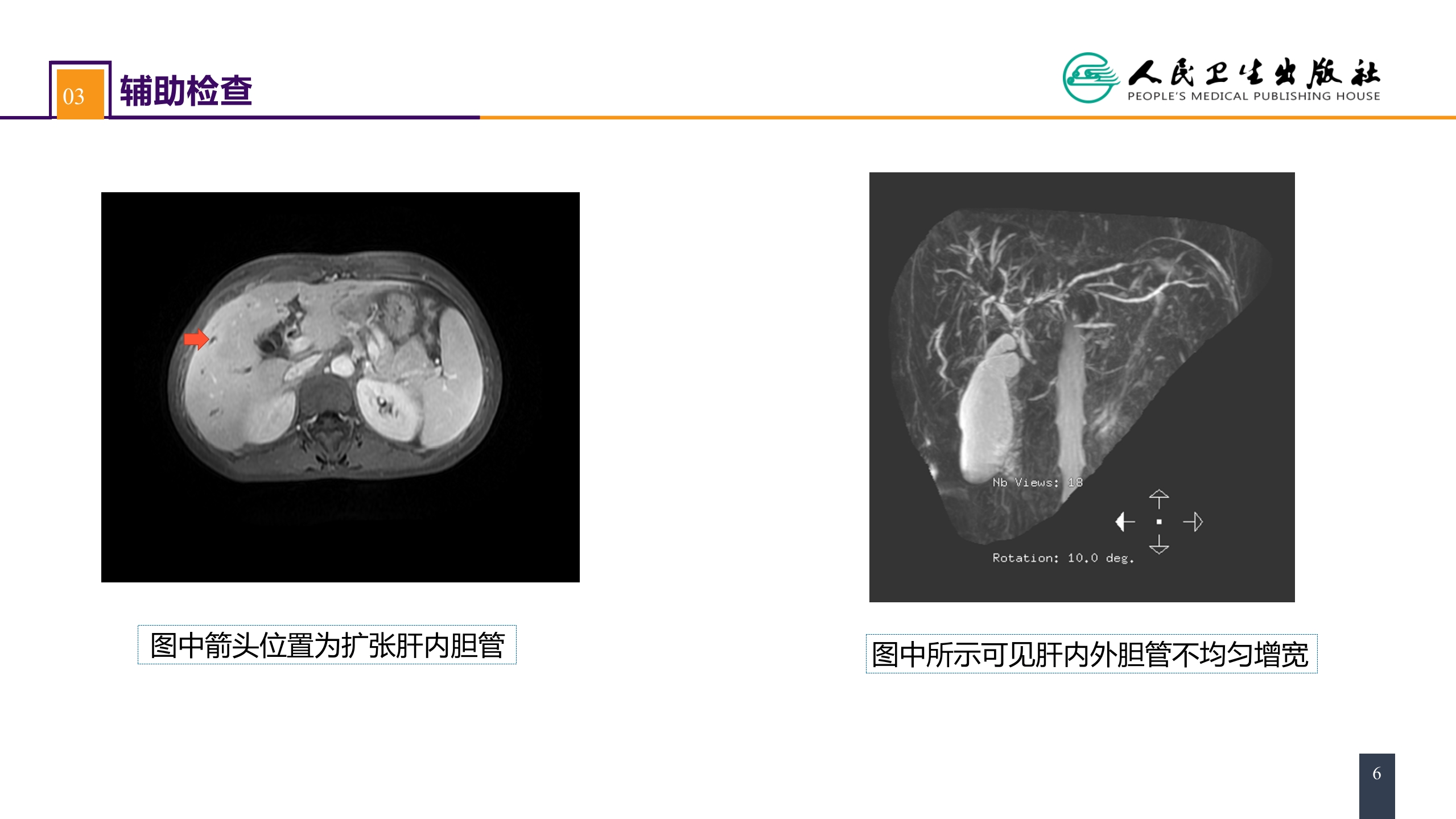 第四十章 胆道疾病 案例分析-原发性硬化性胆管炎