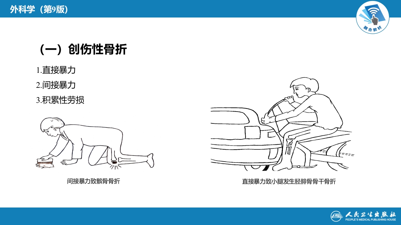 第五十八章 骨折概论