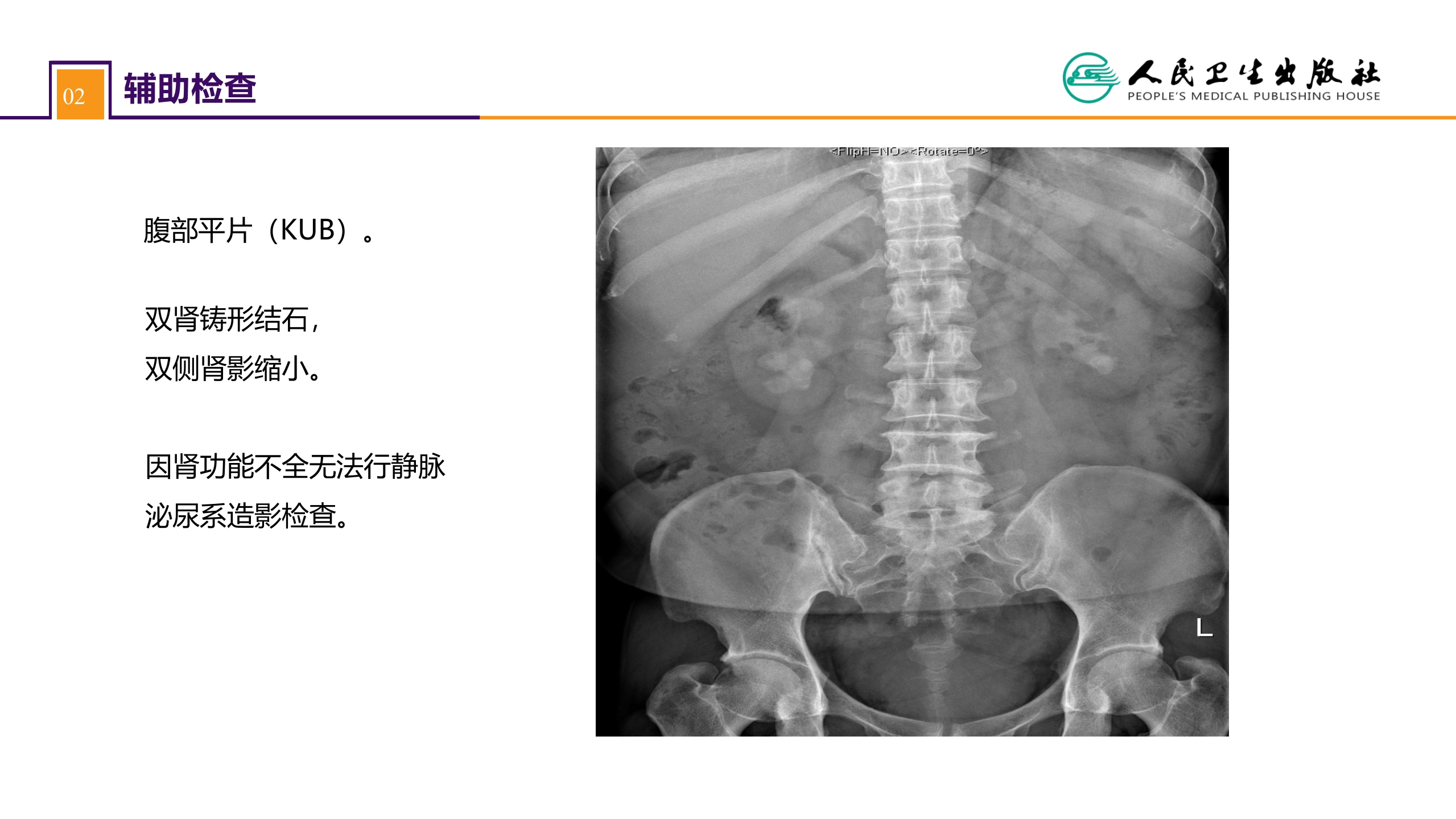 第五十二章 案例分析-双肾结石并慢性肾功能不全