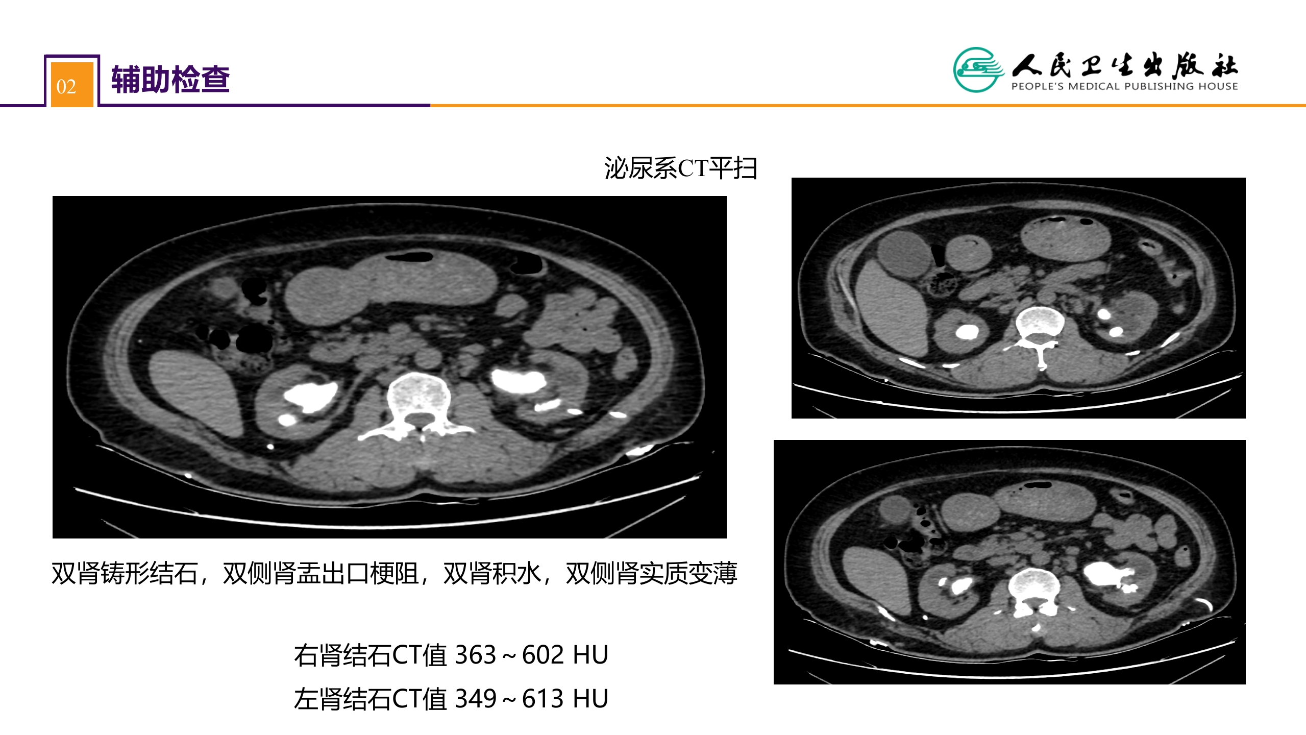 第五十二章 案例分析-双肾结石并慢性肾功能不全