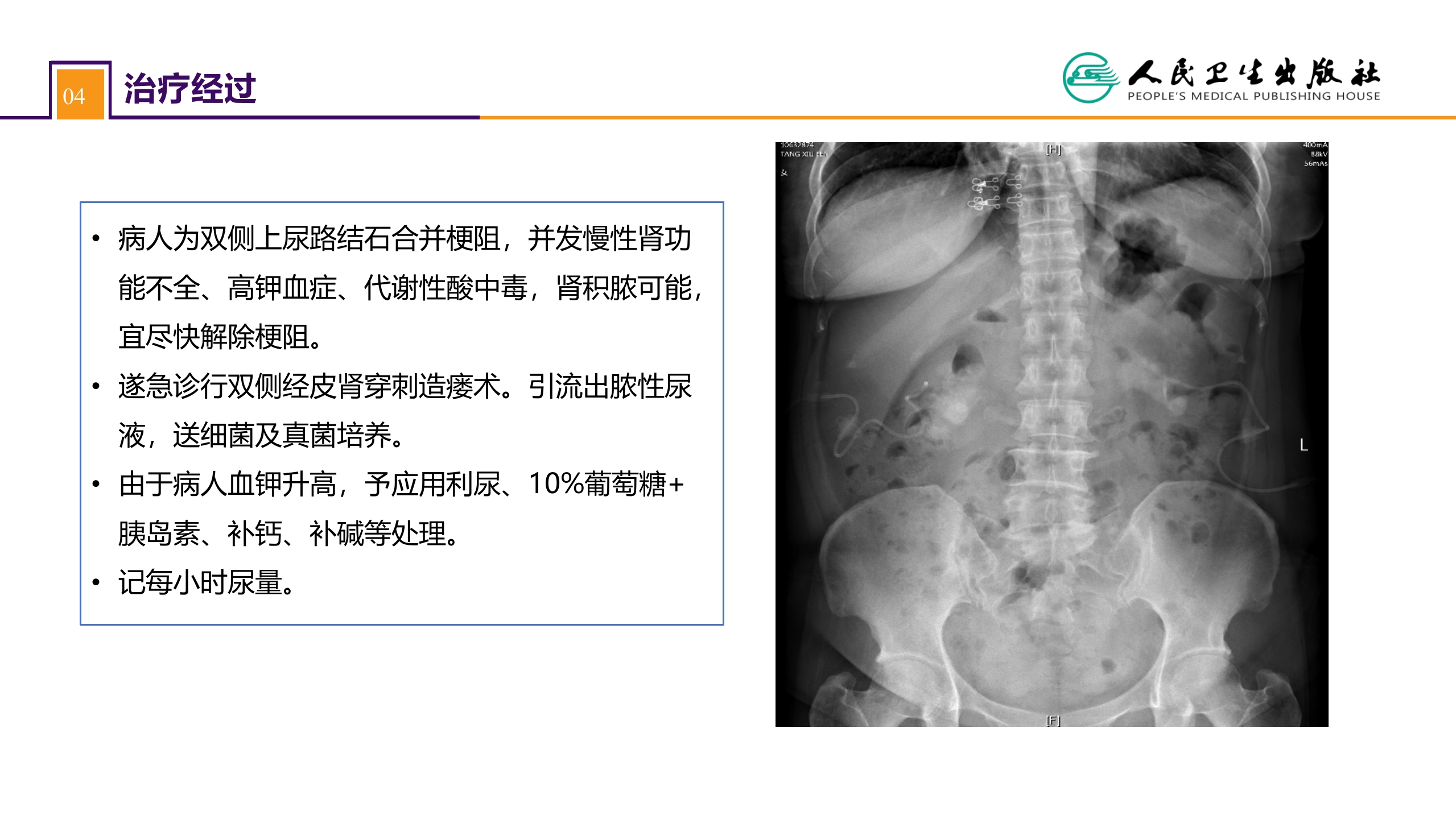 第五十二章 案例分析-双肾结石并慢性肾功能不全