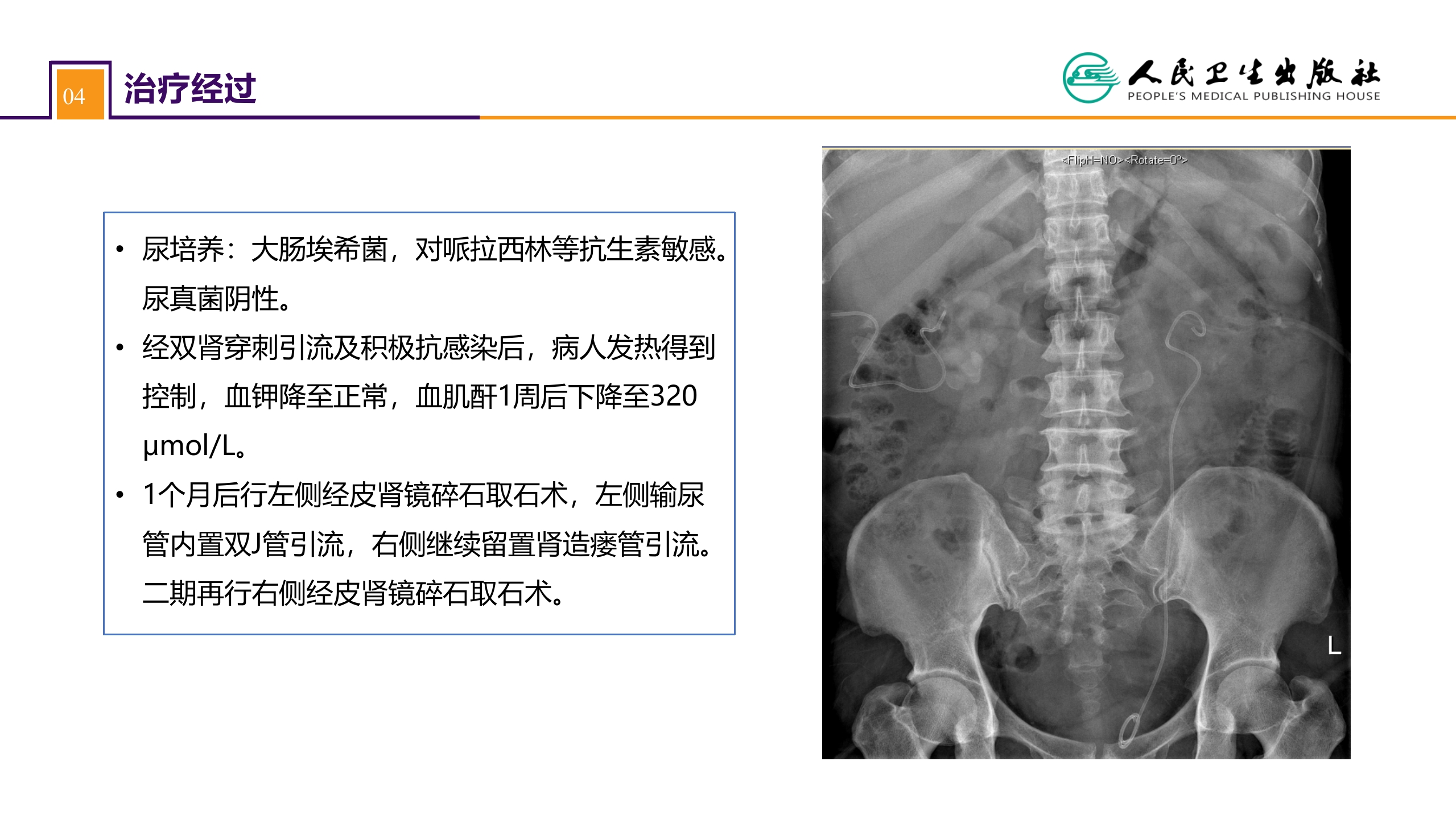 第五十二章 案例分析-双肾结石并慢性肾功能不全