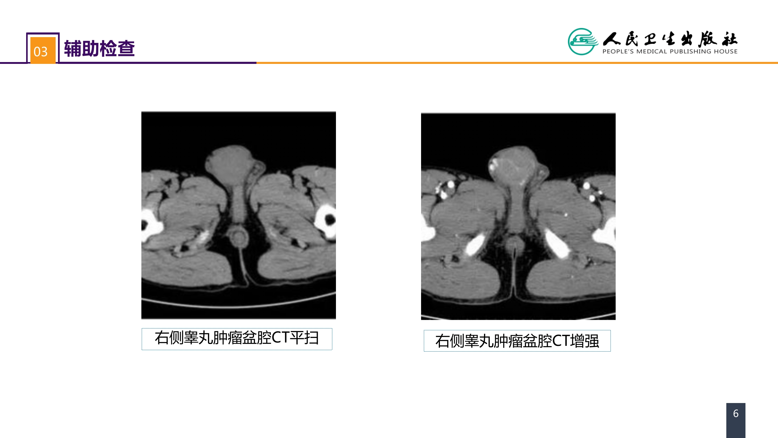 第五十三章 泌尿、男生殖系统肿瘤 案例分析-睾丸肿瘤