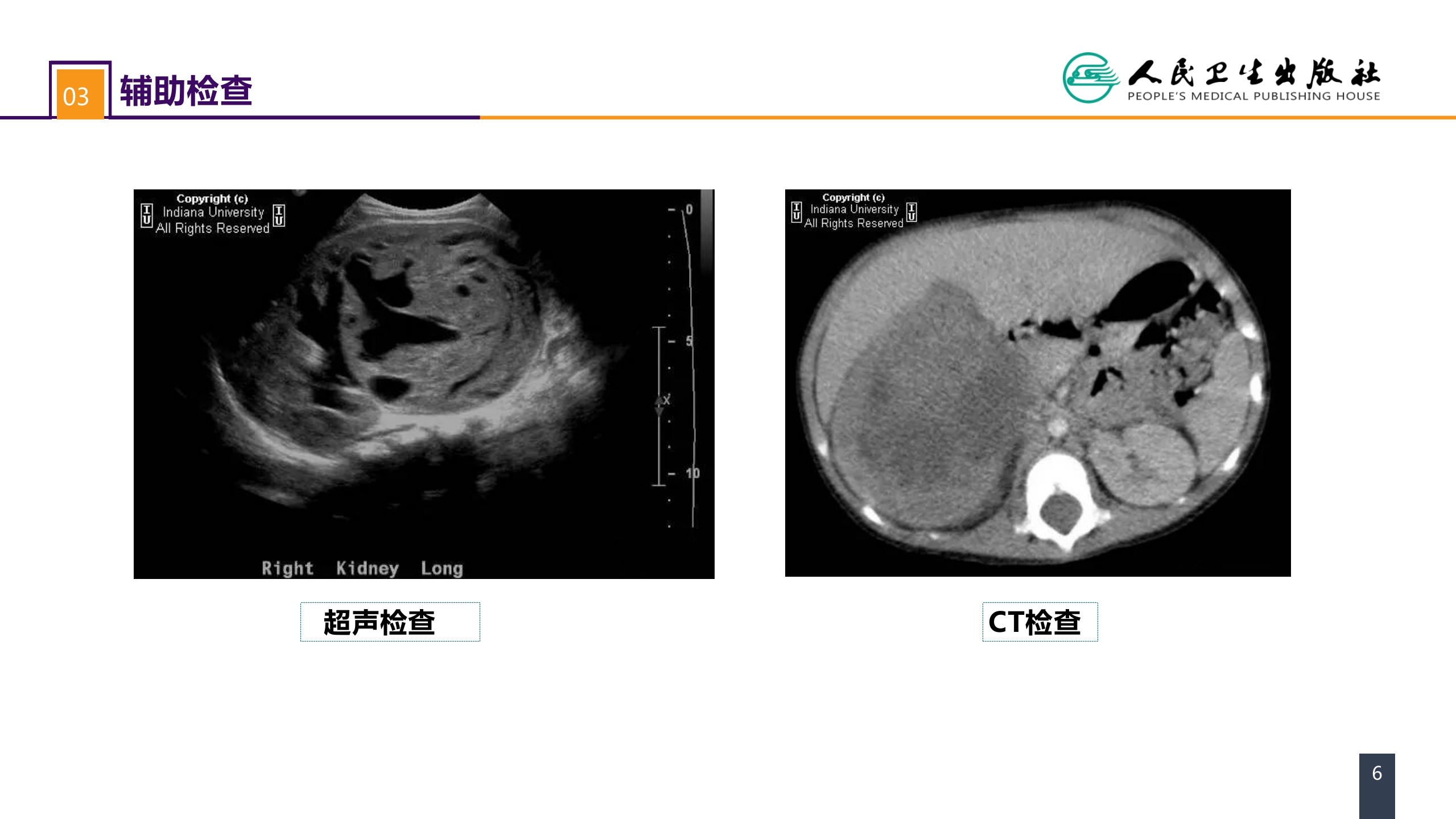 第五十三章 泌尿、男生殖系统肿瘤 案例分析-肾母细胞瘤