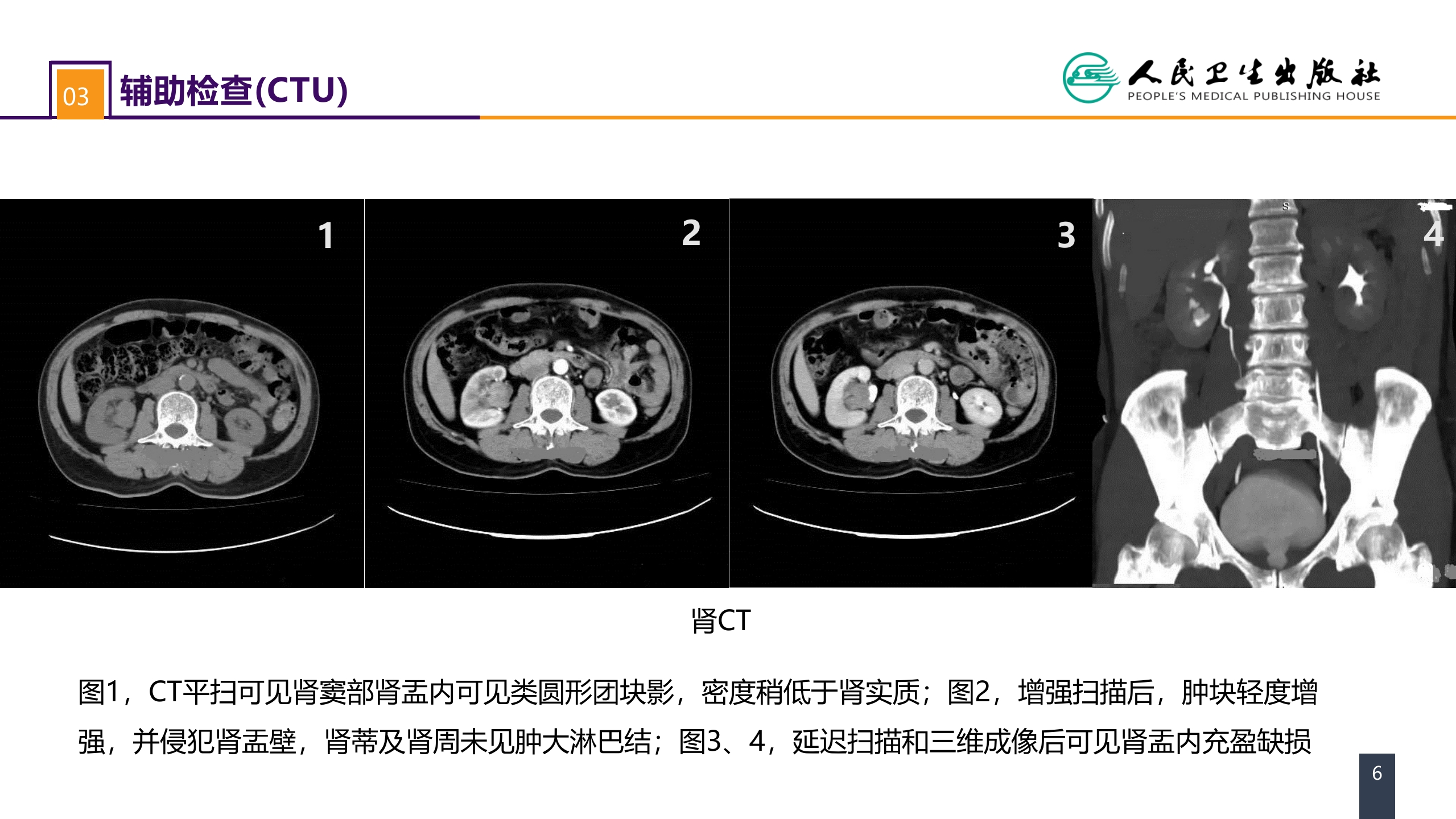 第五十三章 泌尿、男生殖系统肿瘤 案例分析-肾盂癌