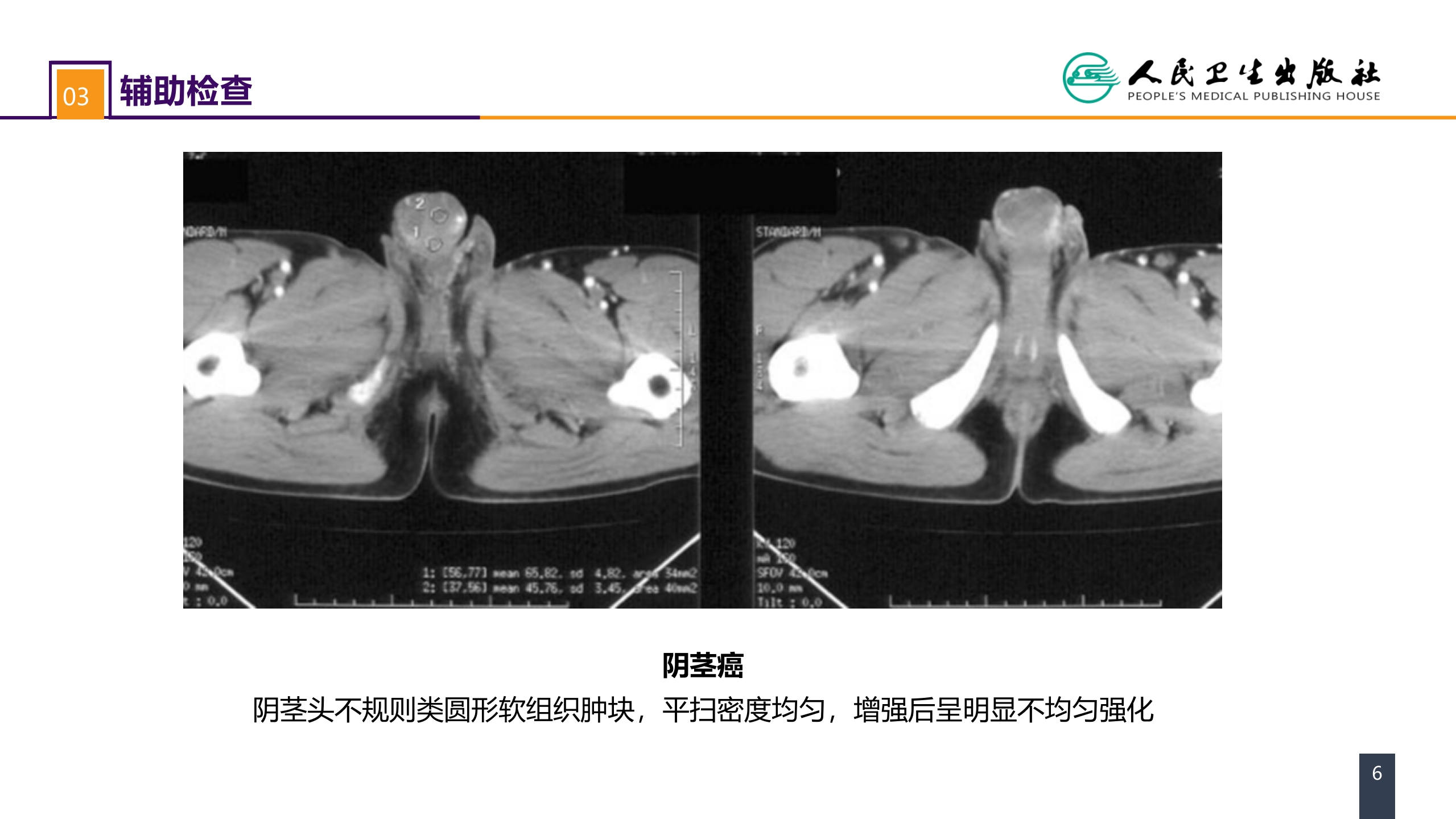 第五十三章 泌尿、男生殖系统肿瘤 案例分析-阴茎癌