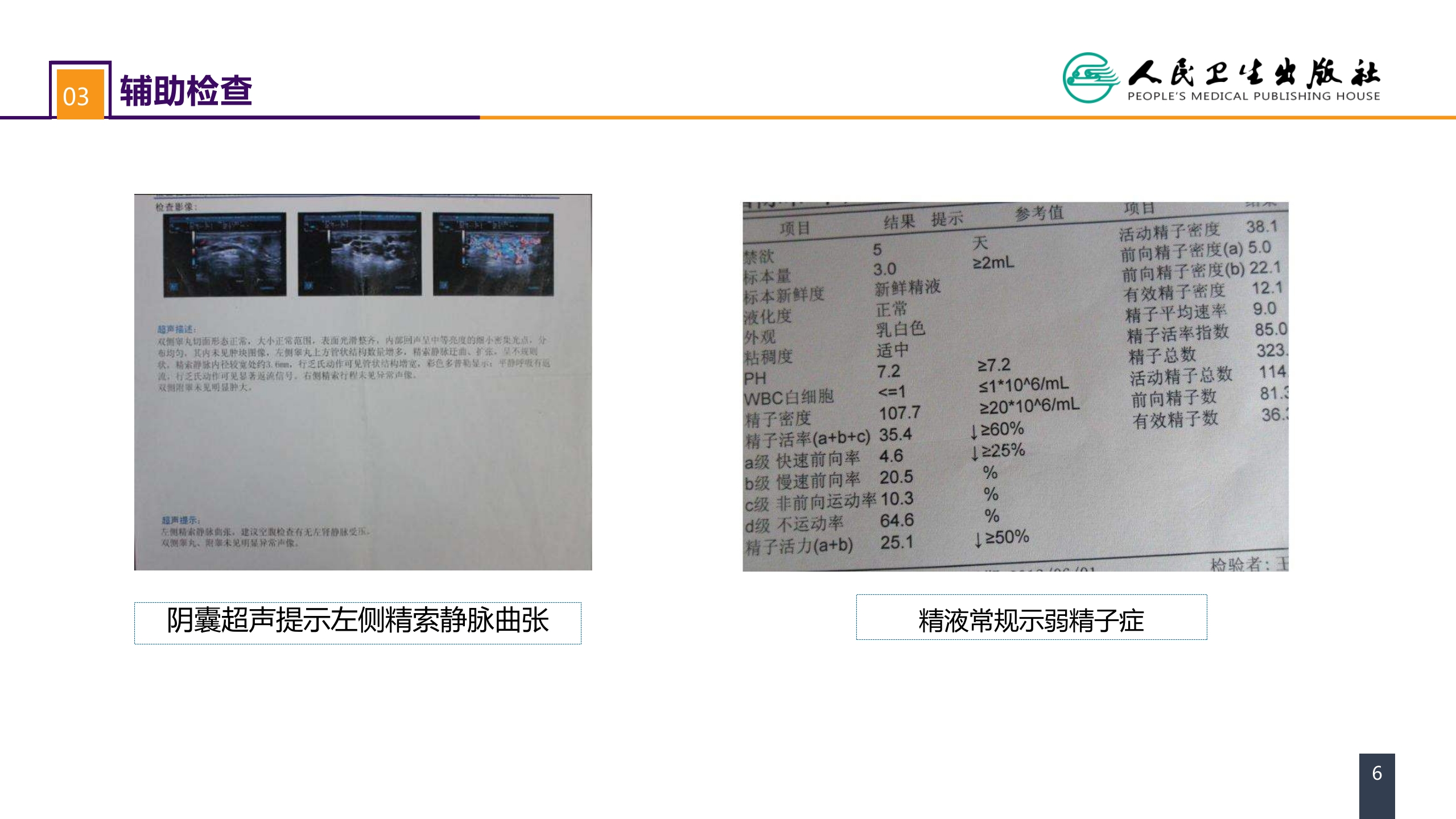 第五十四章 案例分析-精索静脉曲张