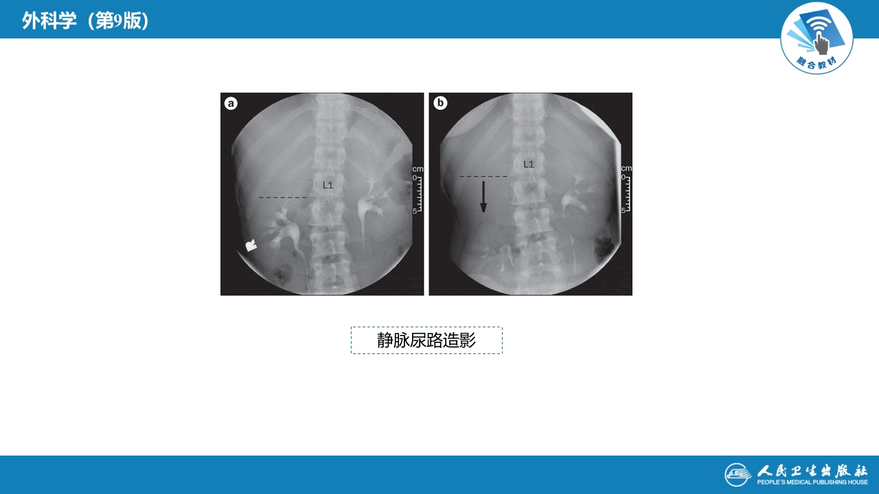 第五十四章 泌尿、男生殖系统的其他疾病