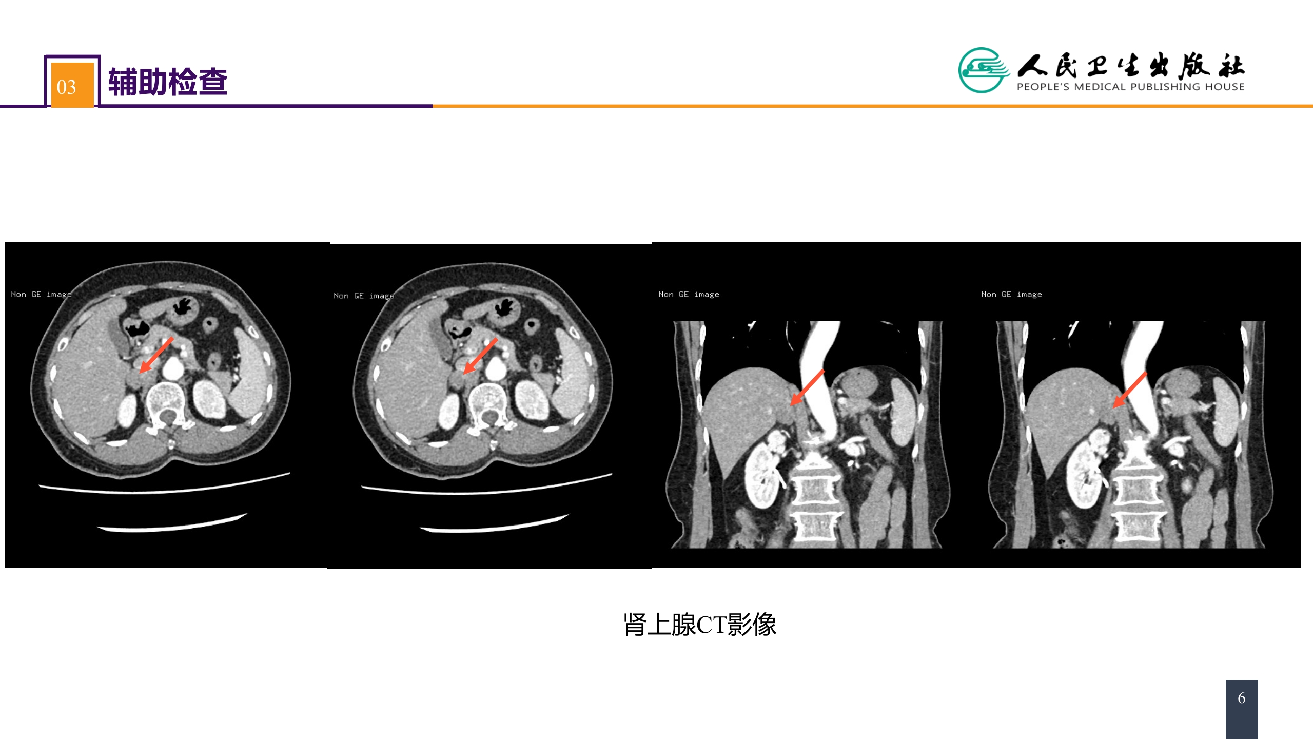 第五十五章 案例分析-原发性醛固酮增多症