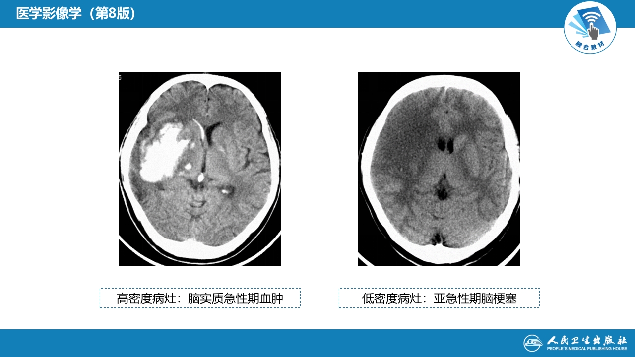 第二章 中枢神经系统 第三节 基本病变表现