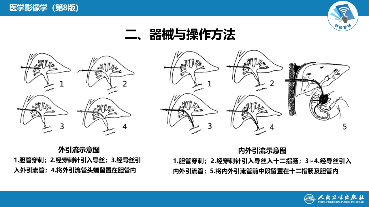 第十四章 非血管疾病介入治疗