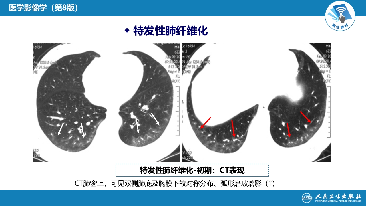 第四章 呼吸系统 第四节 疾病诊断-弥漫性肺疾病、肺肿瘤