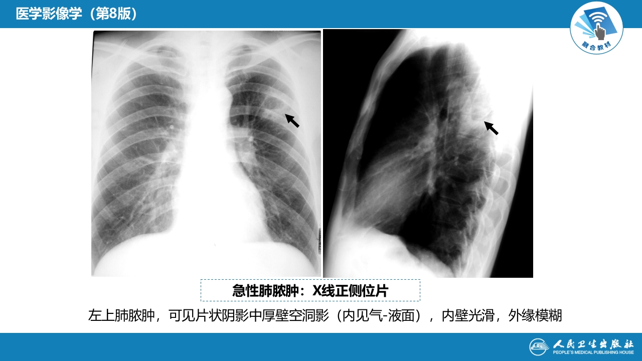 第四章 呼吸系统 第四节 疾病诊断-肺脓肿、肺结核
