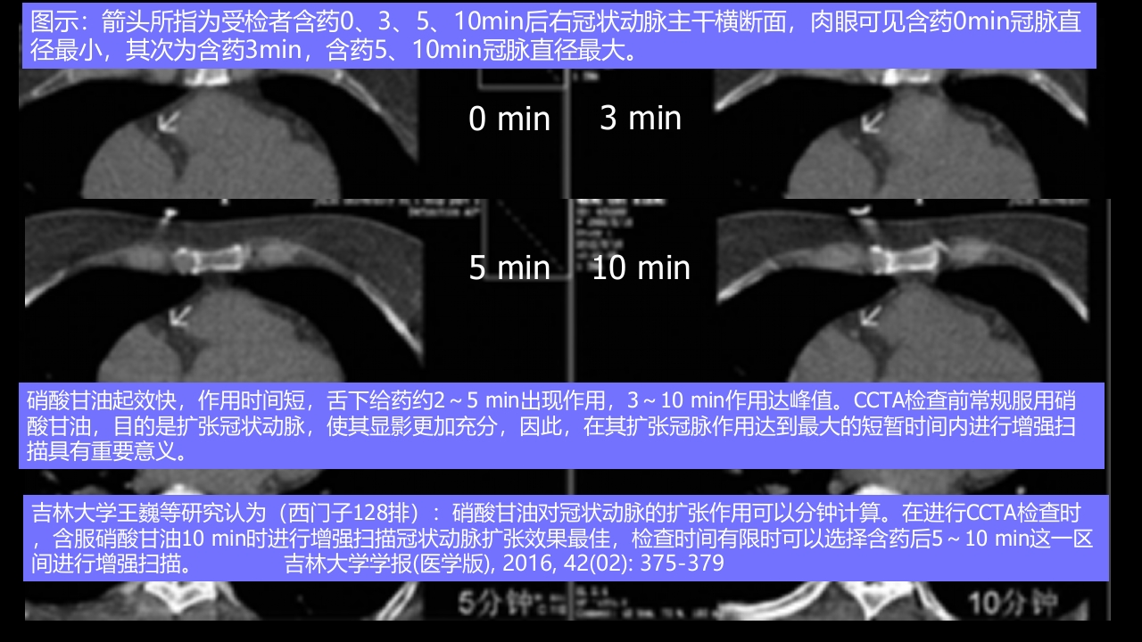 多层螺旋CT冠状动脉疾病诊断再学习之二