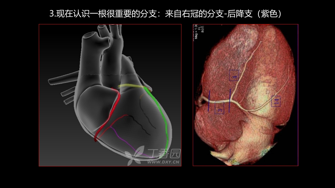 多层螺旋CT冠状动脉疾病诊断再学习之一