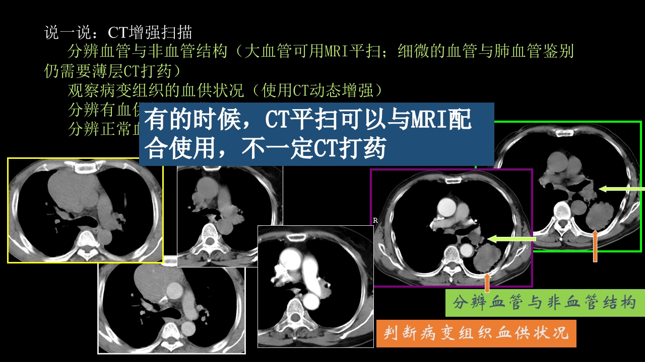 肺癌的综合影像学诊断