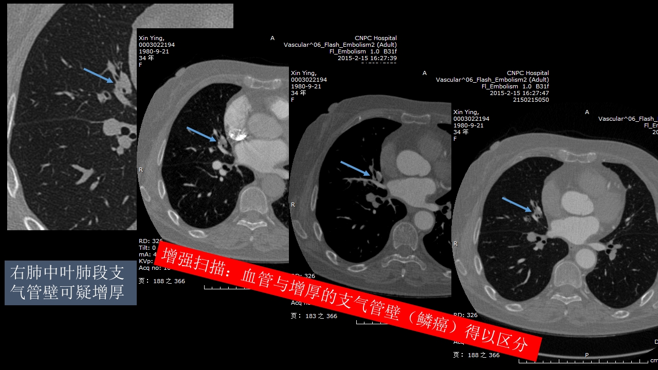 肺癌的综合影像学诊断