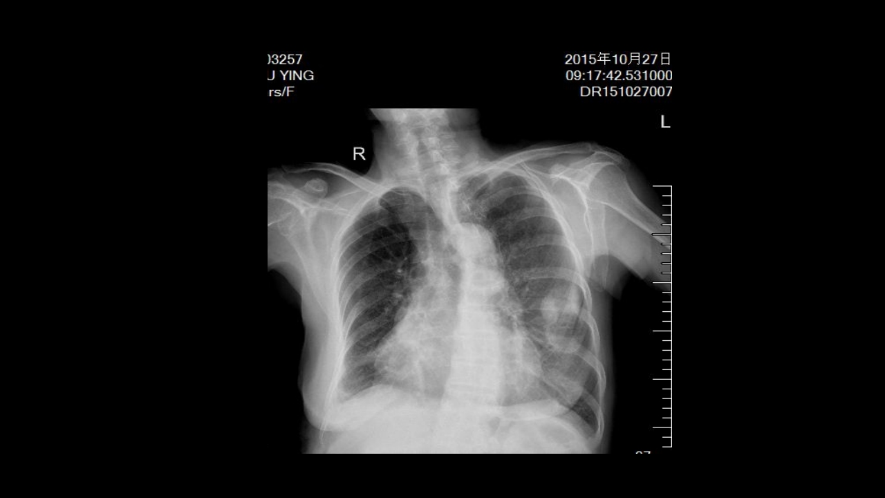 肺部空洞性病变CT与MRI