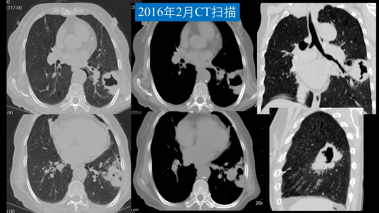肺部空洞性病变CT与MRI