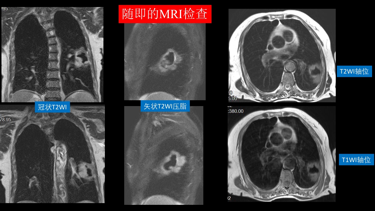 肺部空洞性病变CT与MRI