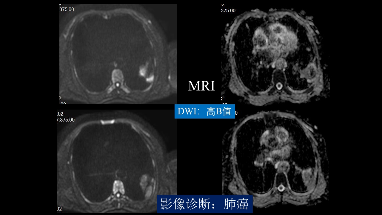 肺部空洞性病变CT与MRI
