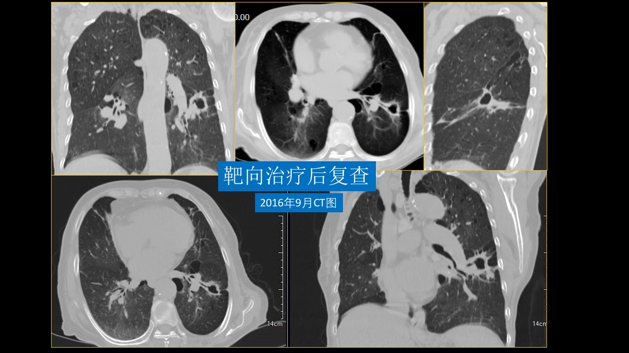 肺部空洞性病变CT与MRI