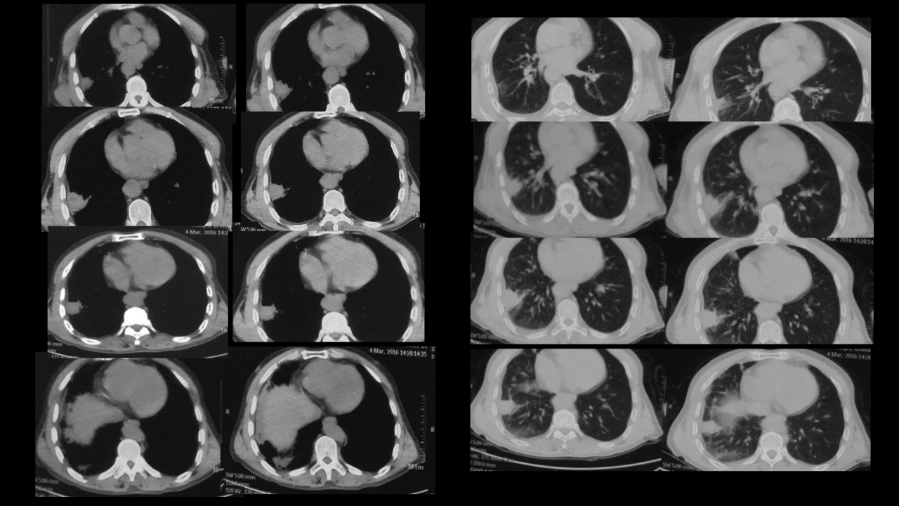 肺部肿块有效的影像检查选择